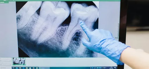 Gloved-Hand-Pointing-to-Tooth-xray-image